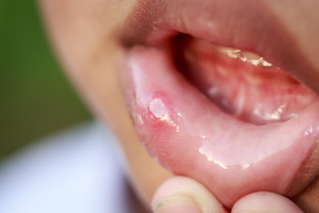 patologia oral afta na boca