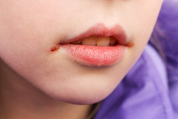 patologia oral machucado na boca