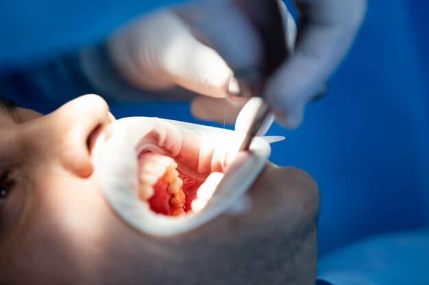 sedação consciente paciente com a boca aberta enquanto dentista faz procedimento