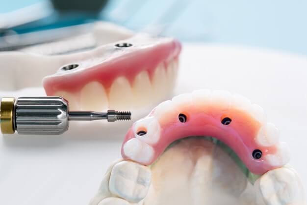 materiais dentarios implante