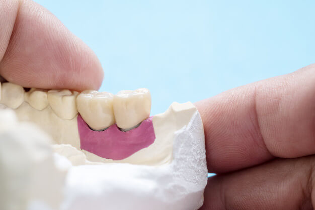 protocolo sobre implantes molares