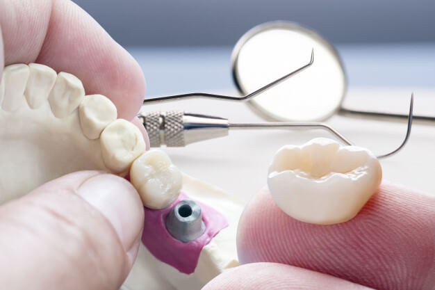 tipos de protese dentaria moderna implante dentario