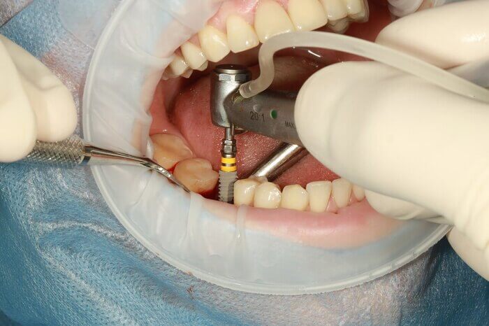 implantodontista procedimento