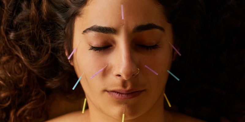 acupuntura tipos de acupuntura