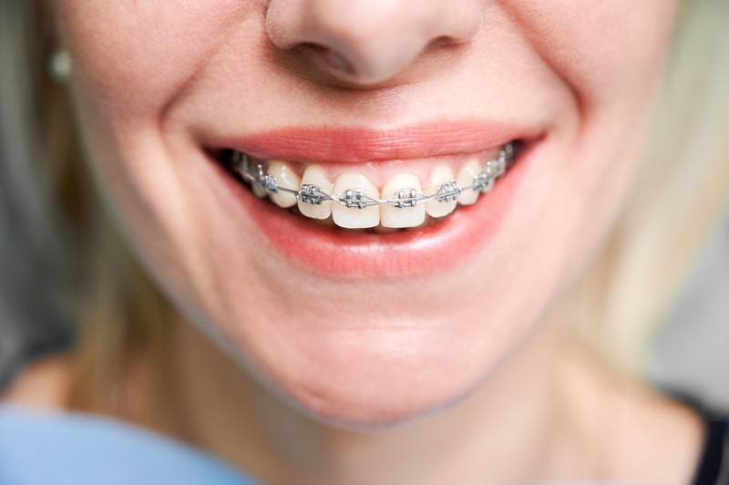 fio ortodontico sorriso