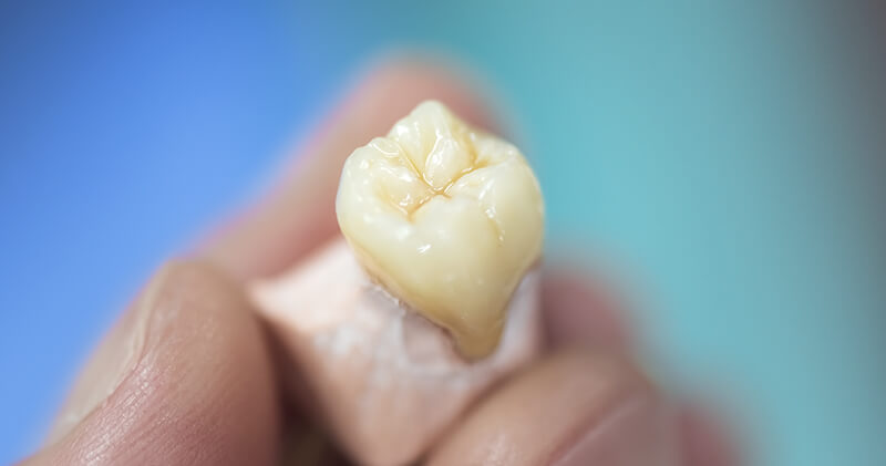 protese adesiva dente