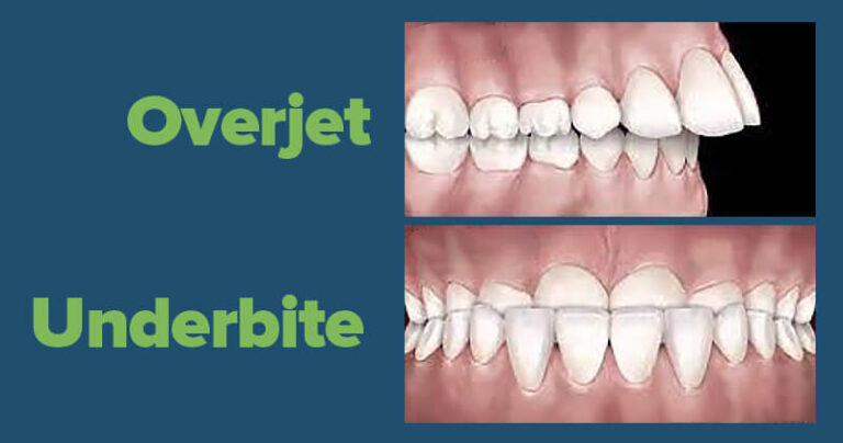 Overjet Como Corrigir Uma Mordida Acentuada